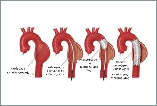 Θεραπεία ανευρύσματος