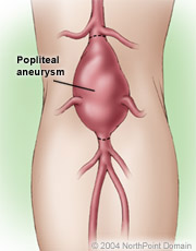 Ανεύρυσμα ιγνυακής αρτηρίας