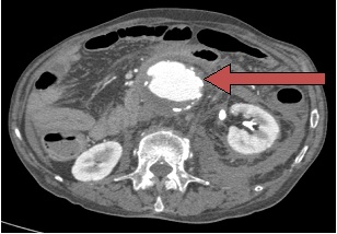 Ανεύρυσμα κοιλιακής αορτής