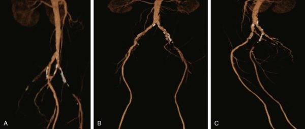 Ισχαιμία κάτω άκρων