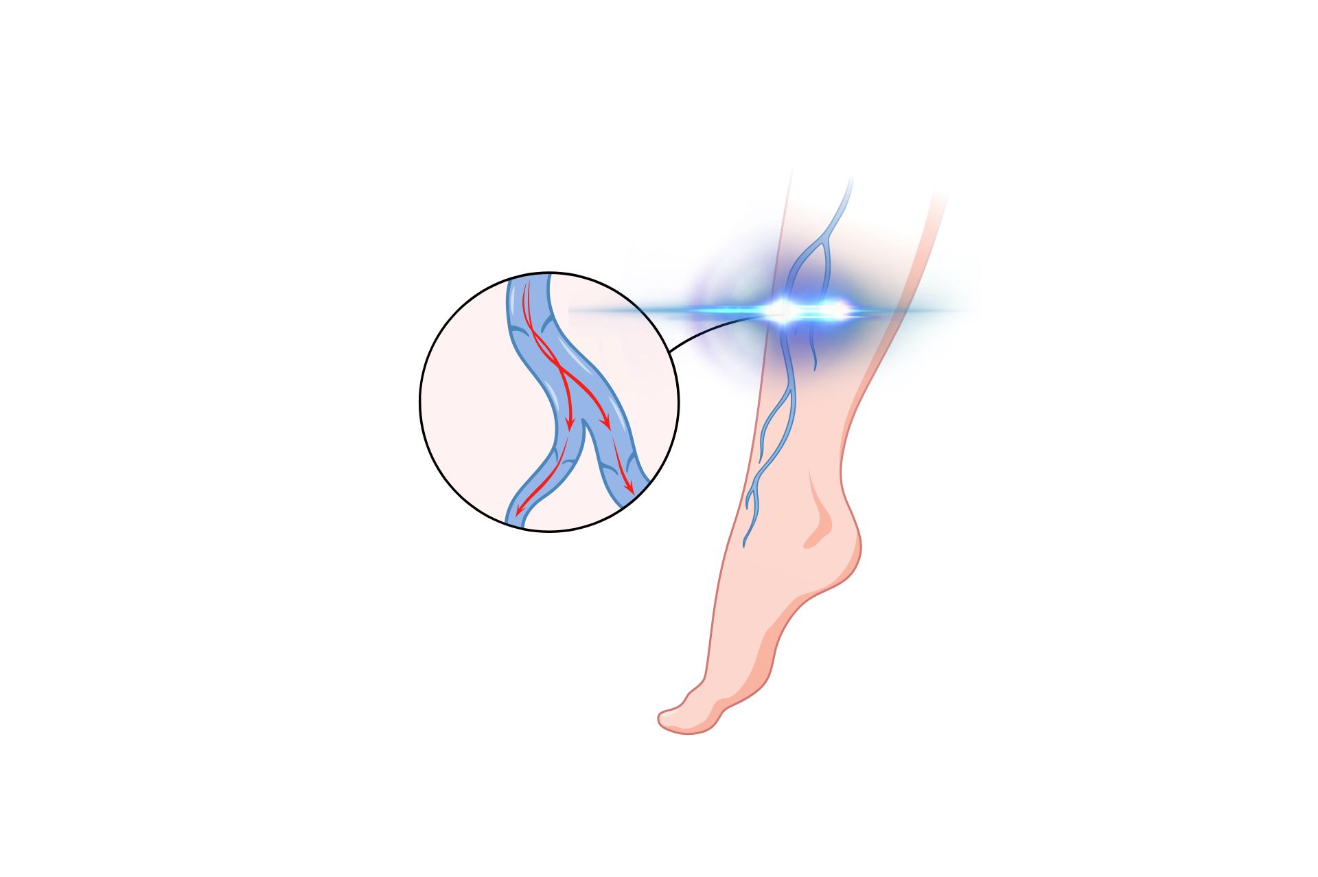 Θεραπεία κιρσών με laser