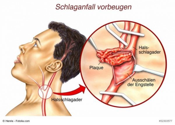 Στένωση καρωτίδας