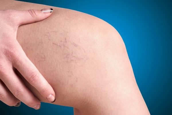 ευρυαγγείες 